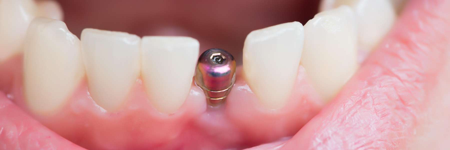 highgate hill dental implants