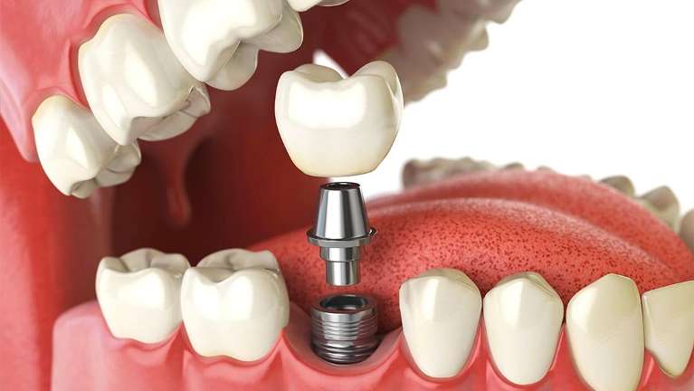 dental implant specialist brisbane