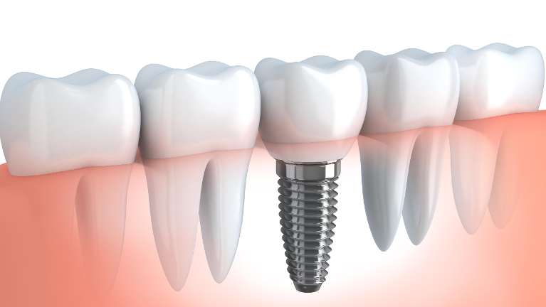 dental implants cost brisbane