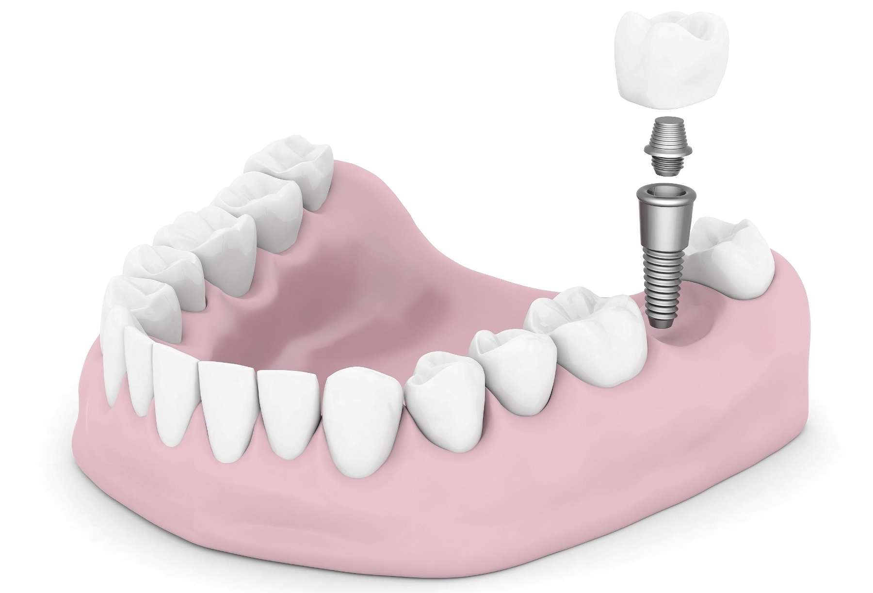 image of a dental implant in highgate hill qld